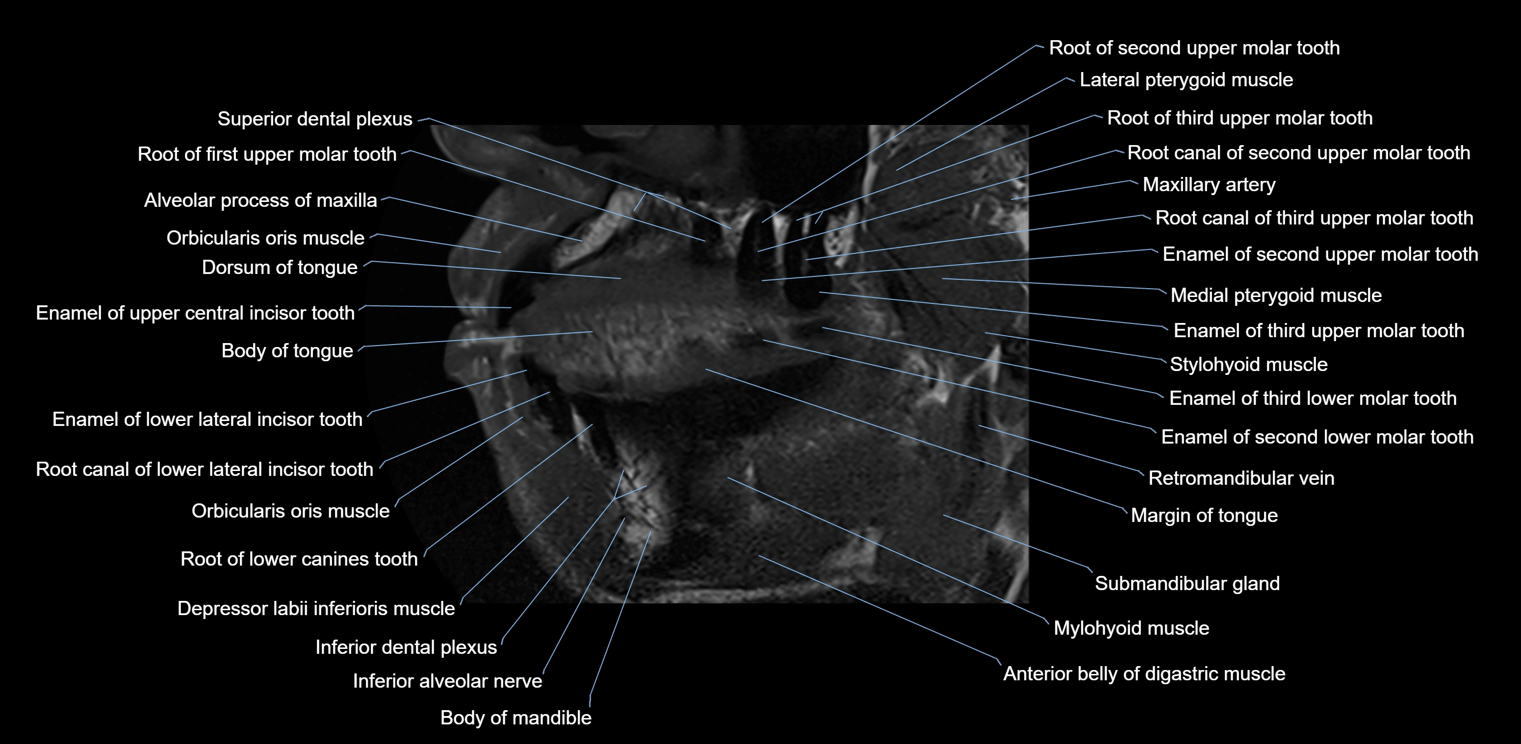 Dental MRI( tooth) sagittal labelled  cross sectional 3T anatomy -img-00001-00010.webp